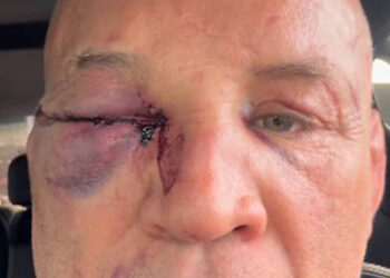 Dor de cabeça que não passa, diz Wanderlei Silva